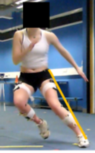 Valgus knee posture indicated by the gap near the knee when a line is drawn from the hip to the ankle