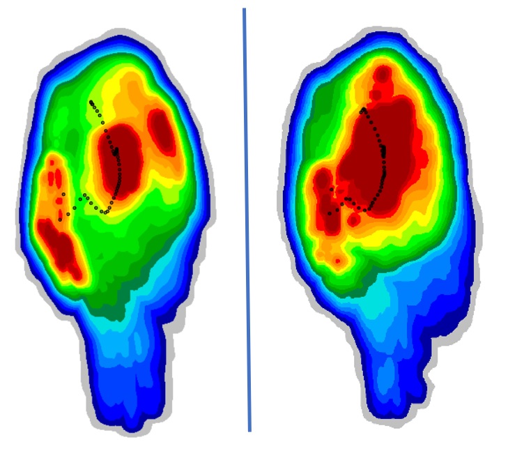 Change of maximal PP during high speed running at 28 km/h after two months of forefoot and 1st ray strengthening on the left foot.
