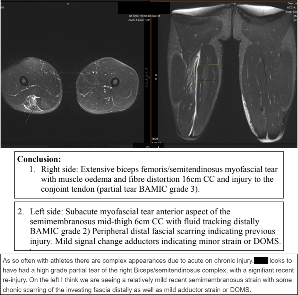 Hamstring strength at every length: Targeting hip extension - Sportsmith